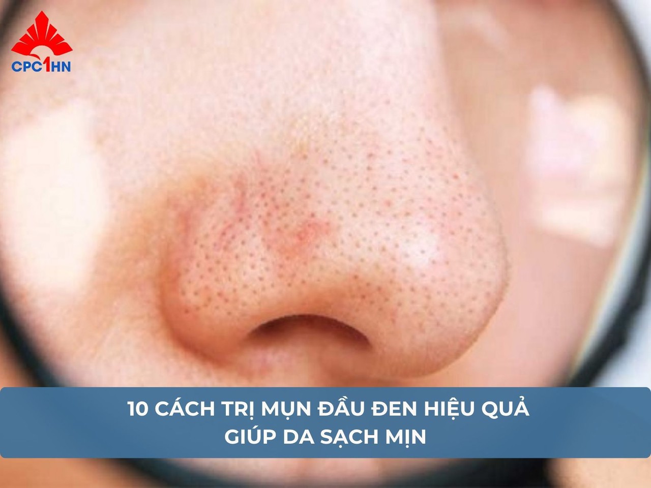 10 cách trị mụn đầu đen hiệu quả giúp da sạch mịn