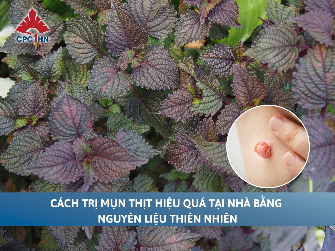 Cách trị mụn thịt hiệu quả tại nhà bằng nguyên liệu thiên nhiên