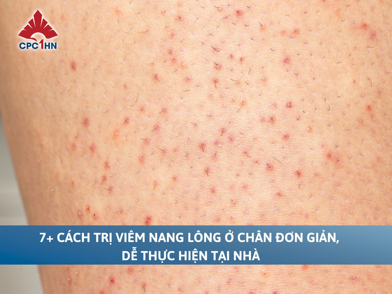 7+ cách trị viêm nang lông ở chân đơn giản, dễ thực hiện tại nhà