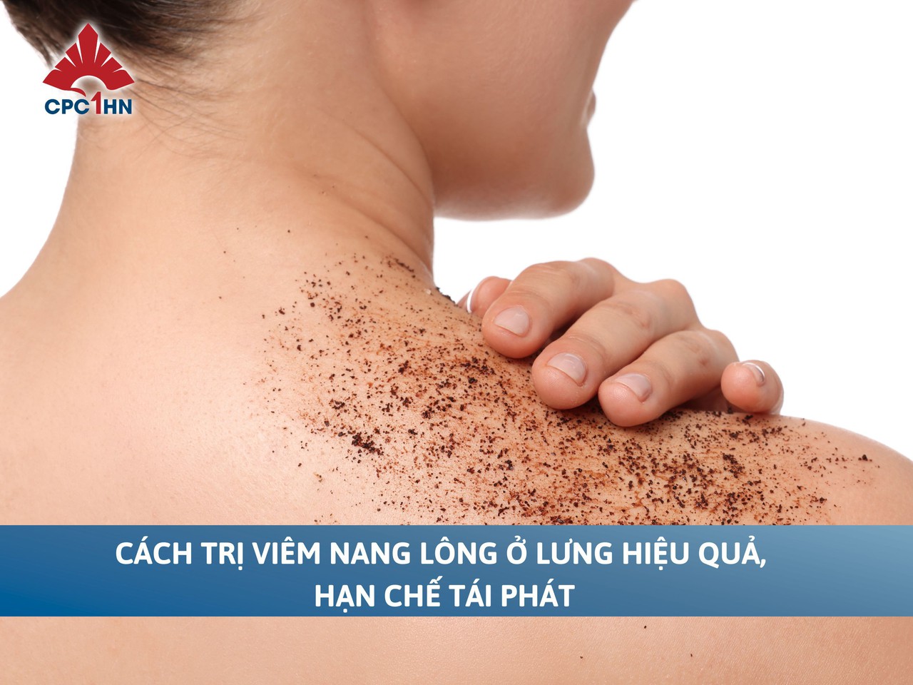 Cách trị viêm nang lông ở lưng hiệu quả, hạn chế tái phát