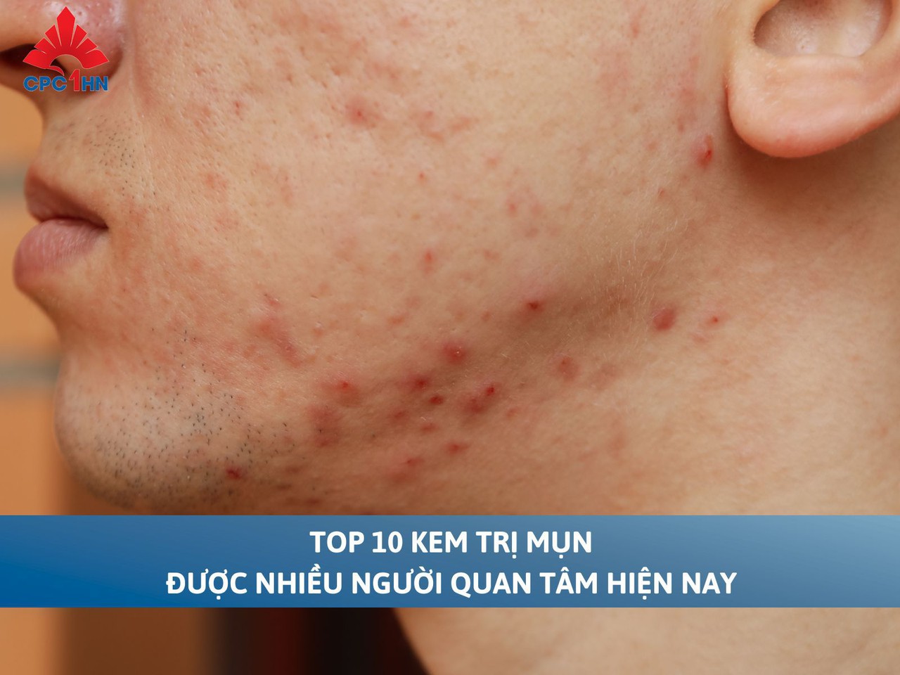 Top 10 kem trị mụn được nhiều người quan tâm hiện nay