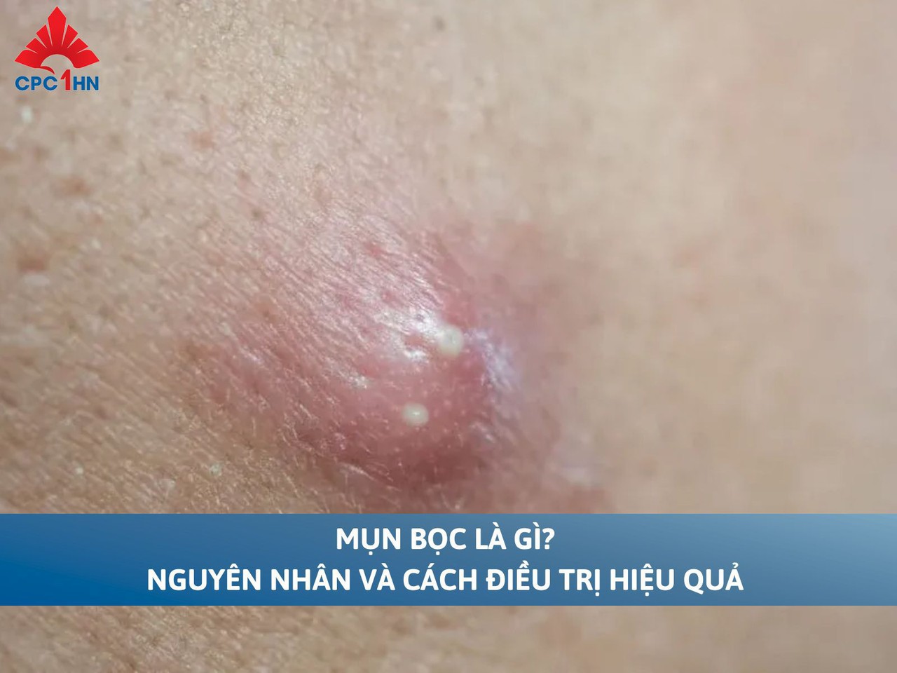 Mụn bọc là gì? Nguyên nhân và cách điều trị hiệu quả