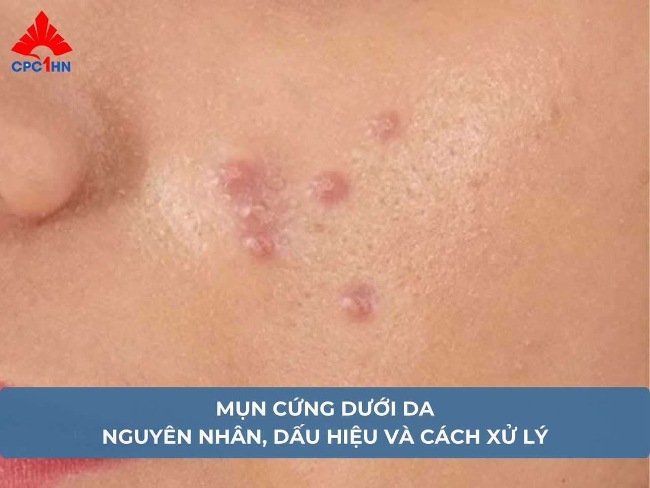 Mụn cứng dưới da: Nguyên nhân, dấu hiệu và cách xử lý