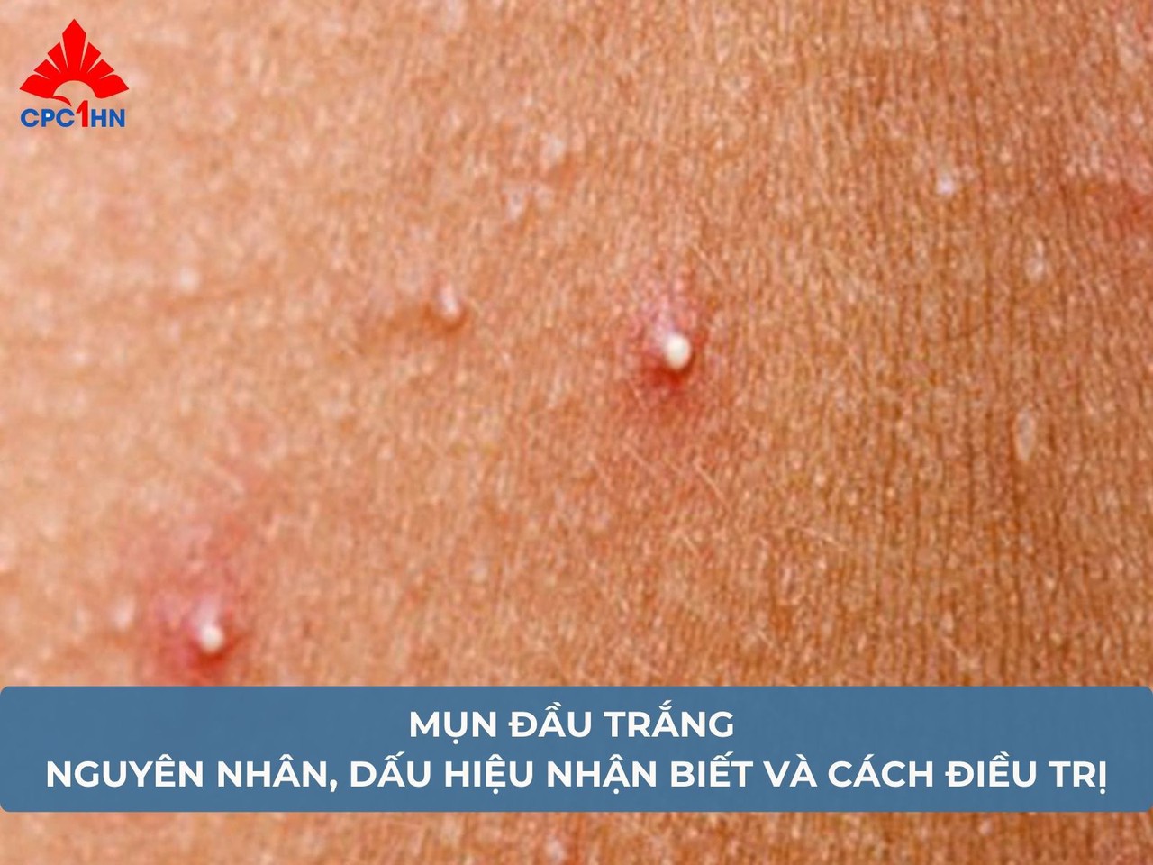 Mụn đầu trắng: Nguyên nhân, dấu hiệu nhận biết và cách điều trị