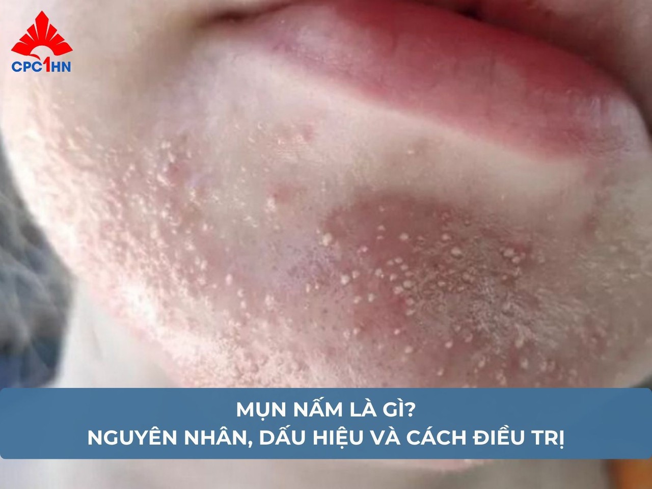 Mụn nấm là gì? Nguyên nhân, dấu hiệu và cách điều trị