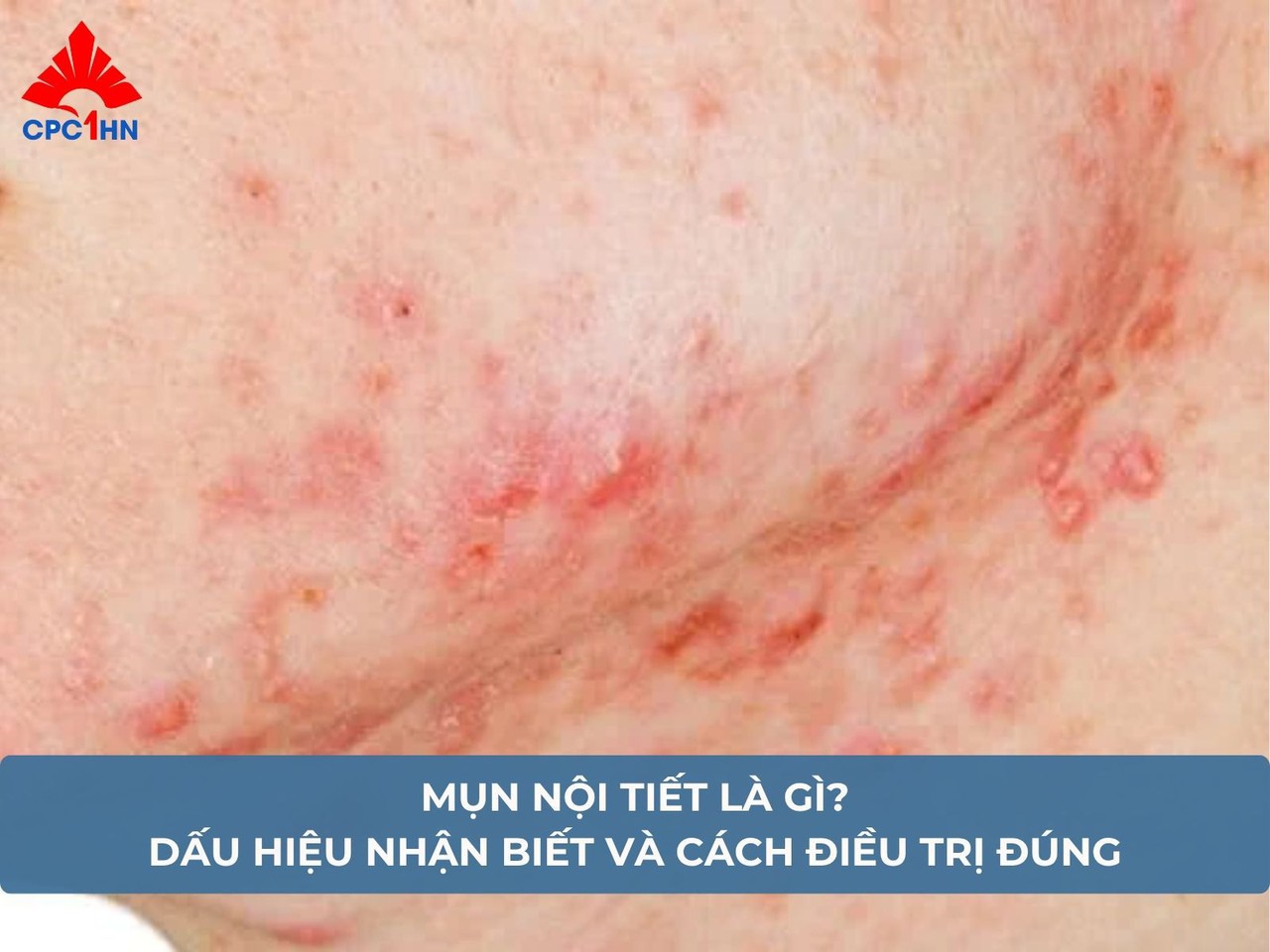 Mụn nội tiết là gì? Dấu hiệu nhận biết và cách điều trị đúng