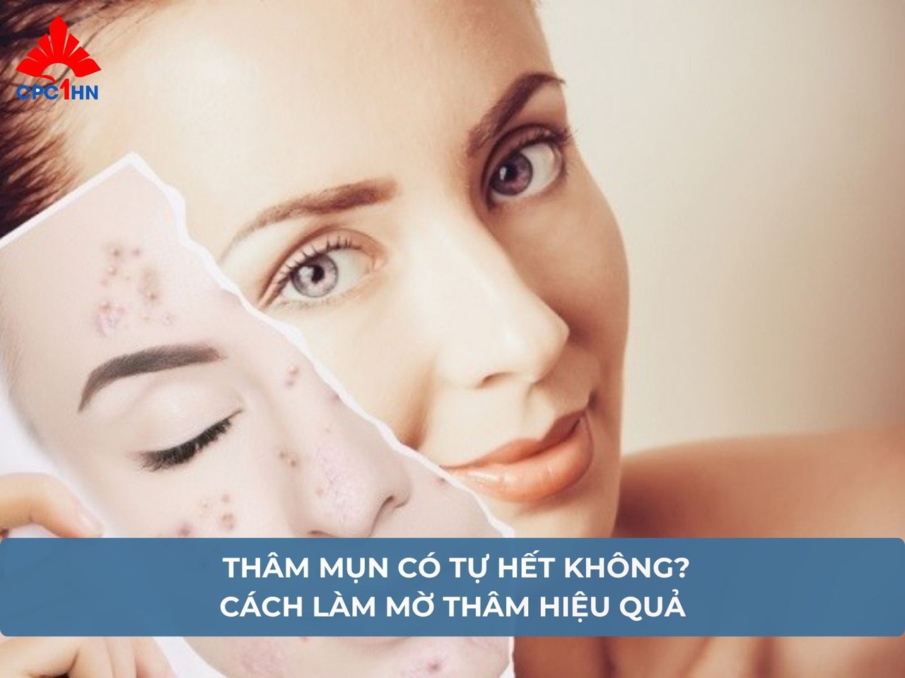 Thâm mụn có tự hết không? Cách làm mờ thâm hiệu quả