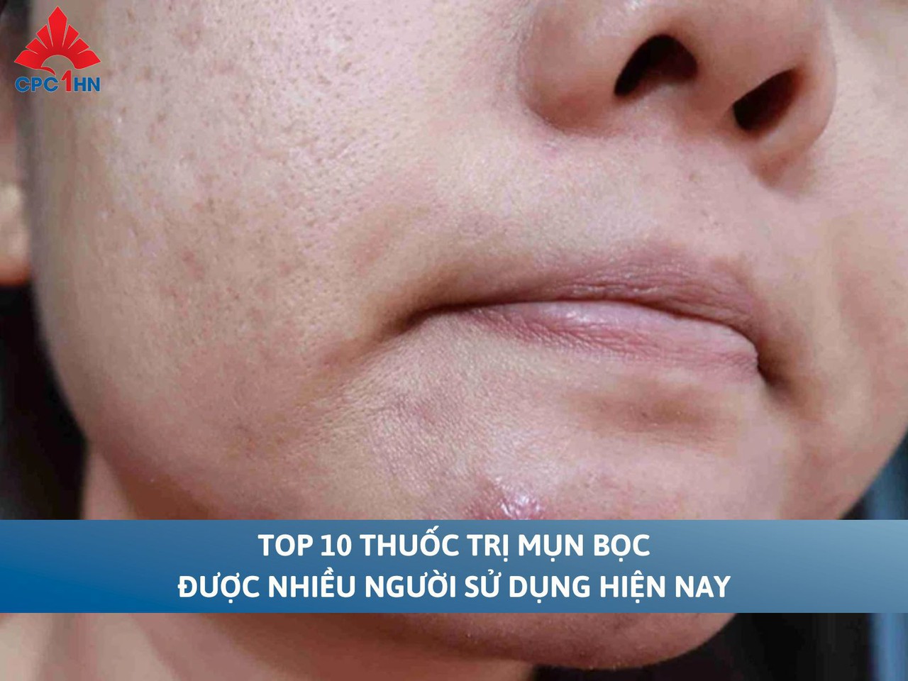 Top 10 thuốc trị mụn bọc được nhiều người sử dụng hiện nay