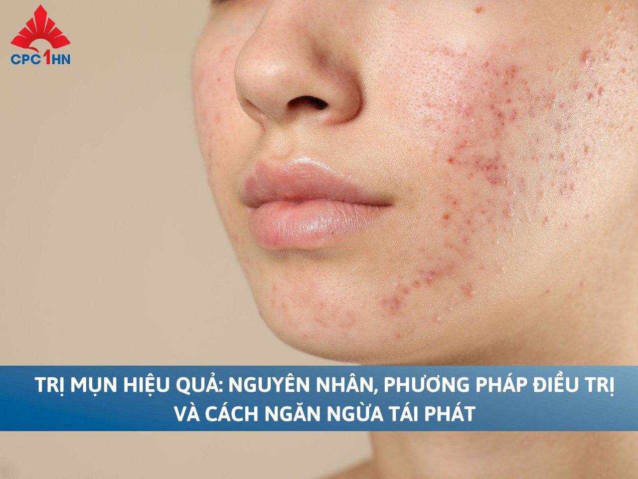 Trị mụn hiệu quả: Nguyên nhân, phương pháp điều trị