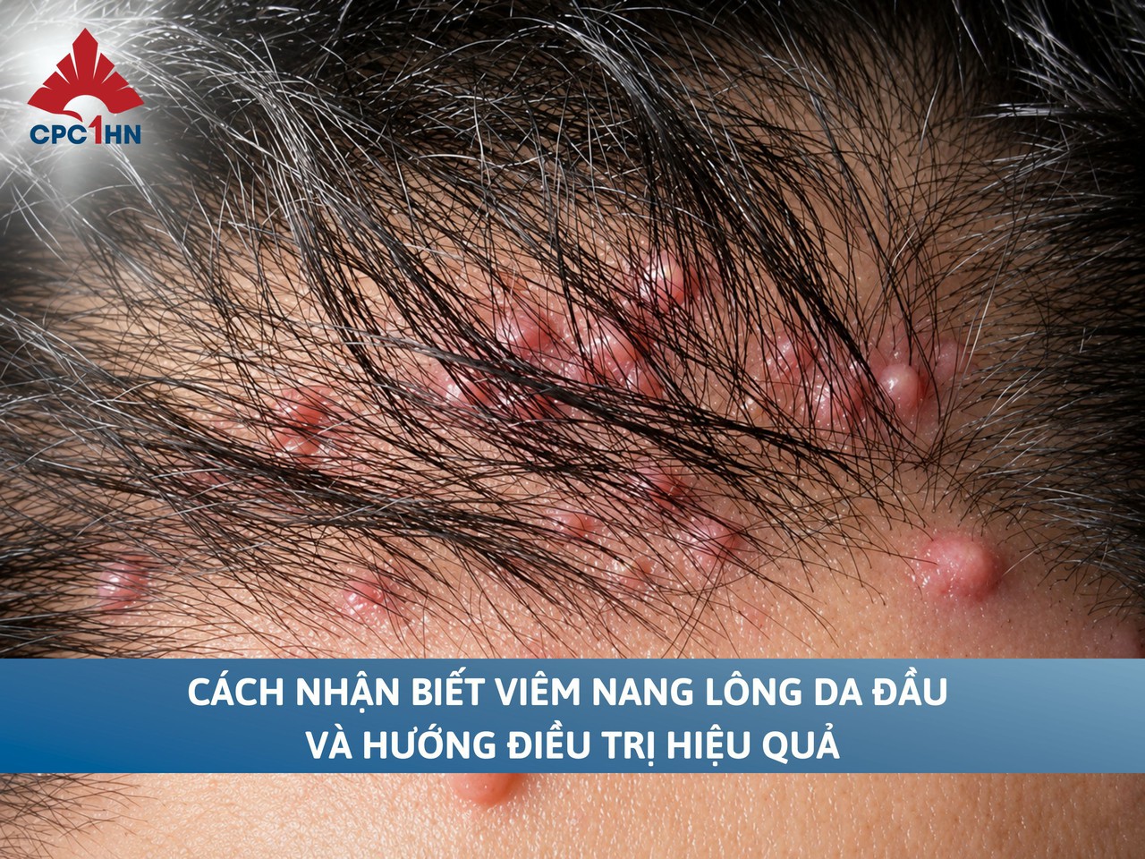 Cách nhận biết viêm nang lông da đầu và hướng điều trị hiệu quả