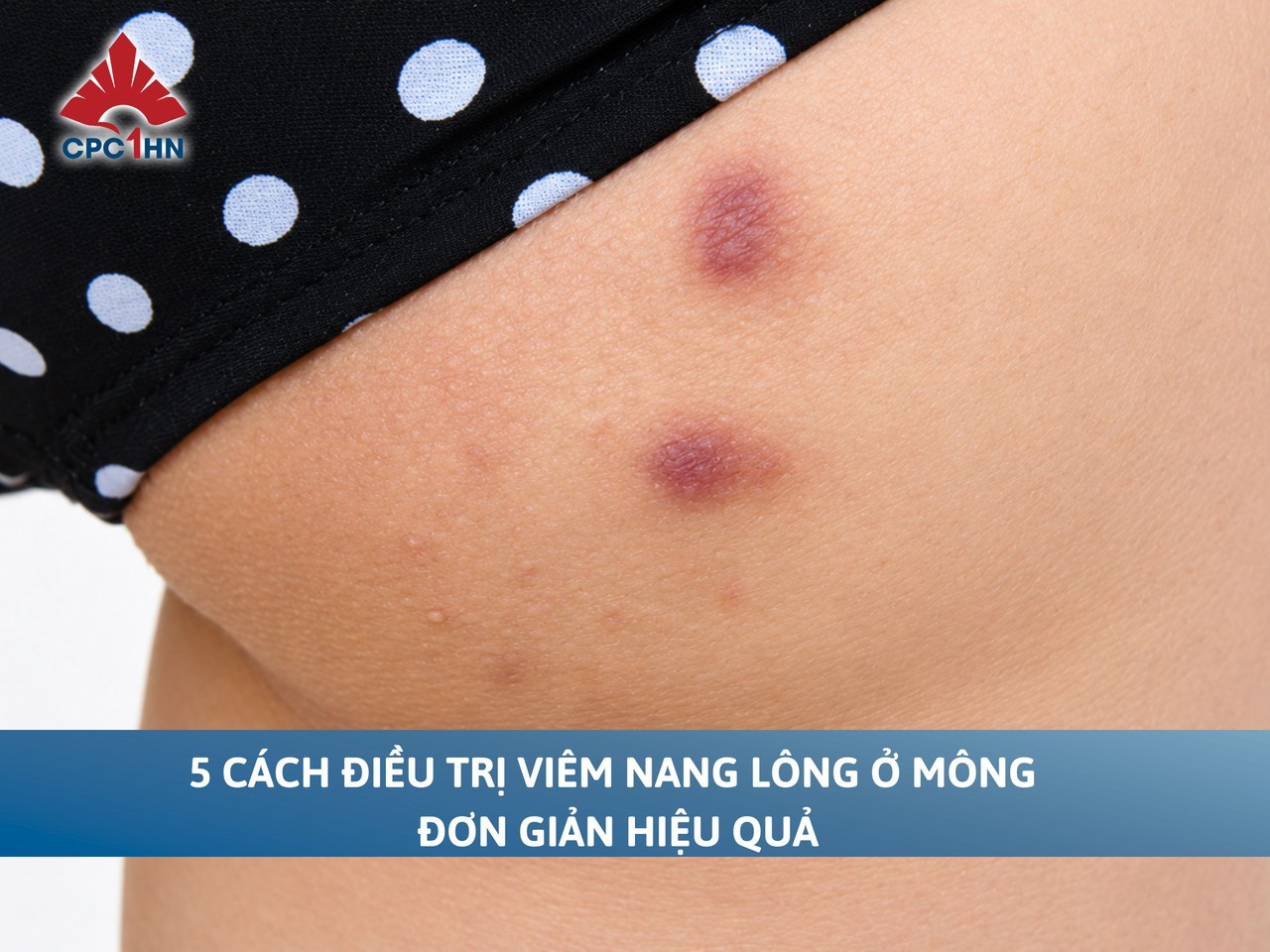 5 cách điều trị viêm nang lông ở mông đơn giản hiệu quả