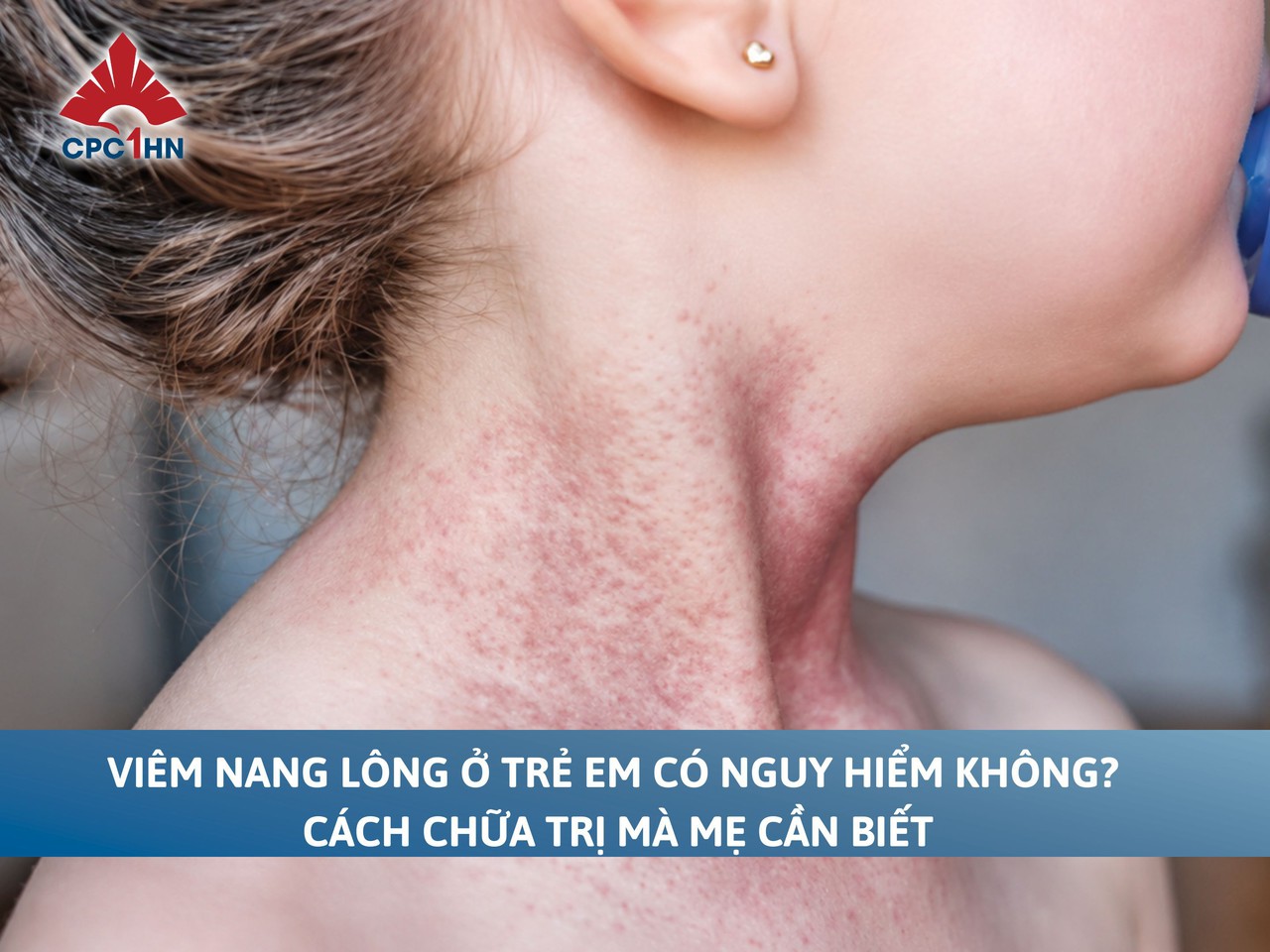 Viêm nang lông ở trẻ em có nguy hiểm không? Cách chữa trị