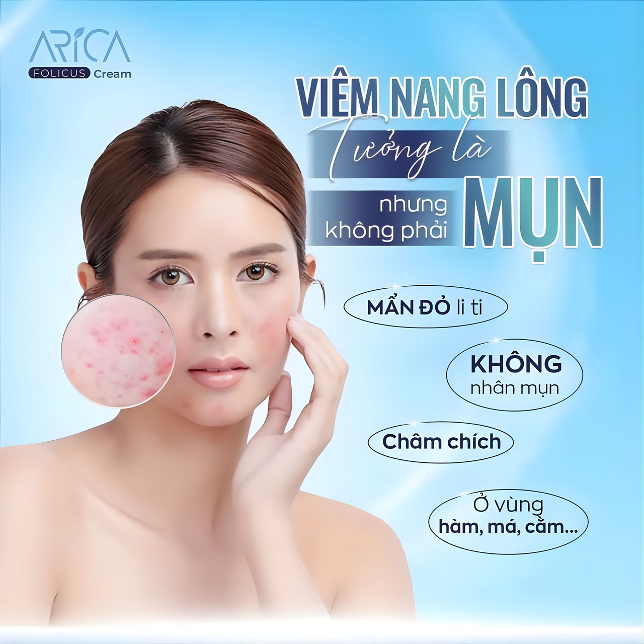 Kem Bôi Viêm Nang Lông Arica Folicus Hỗ Trợ Giảm Mụn Trứng Cá, Dày Sừng, Mơ Thâm Sần (Hộp 1 Tuýp 30g)