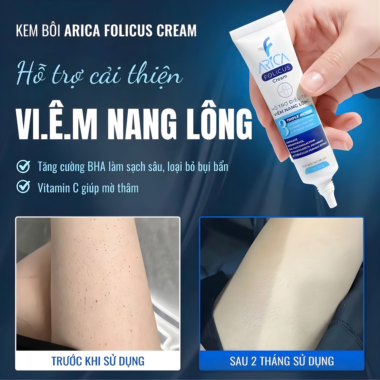 Kem Bôi Viêm Nang Lông Arica Folicus Hỗ Trợ Giảm Mụn Trứng Cá, Dày Sừng, Mơ Thâm Sần (Hộp 1 Tuýp 30g)