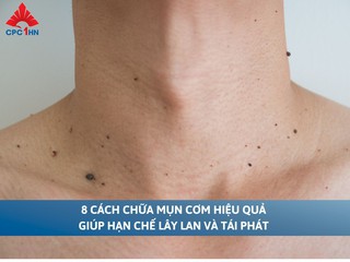 8 cách chữa mụn cơm hiệu quả giúp hạn chế lây lan và tái phát