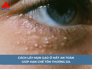 Cách lấy mụn gạo ở mắt an toàn giúp hạn chế tổn thương da