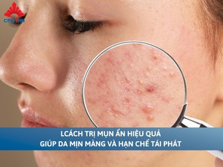 Cách trị mụn ẩn hiệu quả giúp da mịn màng và hạn chế tái phát