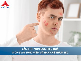 Cách trị mụn bọc hiệu quả giúp giảm sưng viêm và hạn chế thâm sẹo
