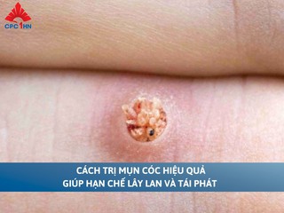 Cách trị mụn cóc hiệu quả giúp hạn chế lây lan và tái phát 