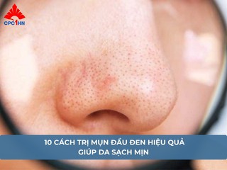 10 cách trị mụn đầu đen hiệu quả giúp da sạch mịn