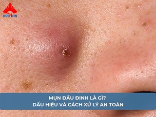 Cách trị mụn đầu đinh tại nhà bằng nguyên liệu dân gian