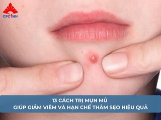 13 cách trị mụn mủ giúp giảm viêm và hạn chế thâm sẹo hiệu quả