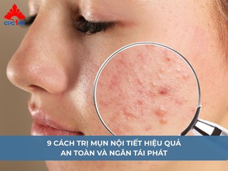 9 cách trị mụn nội tiết hiệu quả, an toàn và ngăn tái phát
