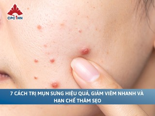 7 cách trị mụn sưng hiệu quả, giảm viêm nhanh và hạn chế thâm sẹo
