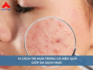 14 cách trị mụn trứng cá hiệu quả giúp da sạch mụn