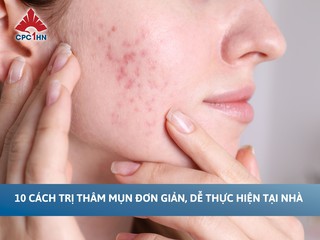 10 cách trị thâm mụn đơn giản, dễ thực hiện tại nhà