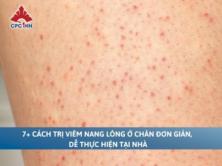 7+ cách trị viêm nang lông ở chân đơn giản, dễ thực hiện tại nhà