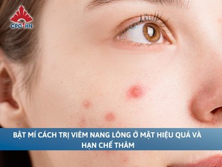 Bật mí cách trị viêm nang lông ở mặt hiệu quả và hạn chế thâm