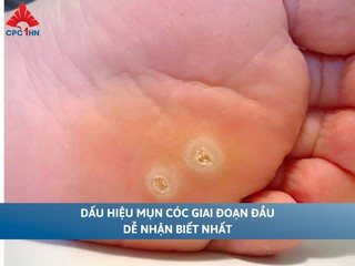 Dấu hiệu mụn cóc giai đoạn đầu dễ nhận biết nhất