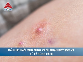 Dấu hiệu nổi mụn sưng: Cách nhận biết sớm và xử lý đúng cách