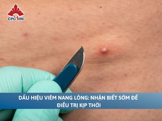 Dấu hiệu viêm nang lông: Nhận biết sớm để điều trị kịp thời