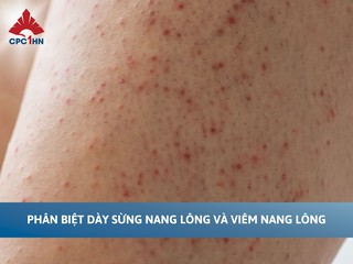 Phân biệt dày sừng nang lông và viêm nang lông