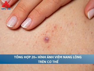 Tổng hợp 20+ hình ảnh viêm nang lông trên cơ thể
