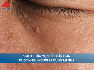 5 mẹo chữa mụn cóc dân gian được nhiều người áp dụng tại nhà