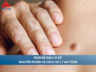 Mụn bã đậu là gì? Nguyên nhân và cách xử lý an toàn