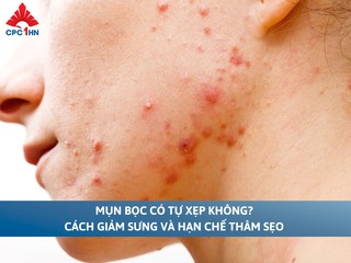 Mụn bọc có tự xẹp không? Cách giảm sưng và hạn chế thâm sẹo