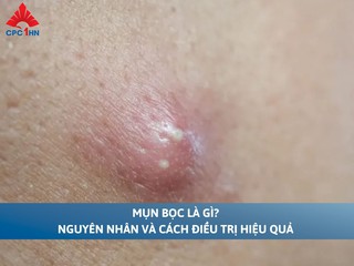 Mụn bọc là gì? Nguyên nhân và cách điều trị hiệu quả
