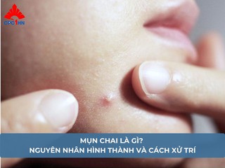 Mụn chai là gì? Nguyên nhân hình thành và cách xử trí