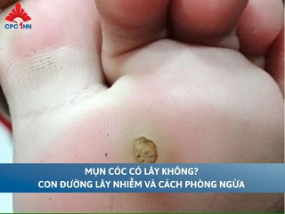 Mụn cóc có lây không? Con đường lây nhiễm và cách phòng ngừa