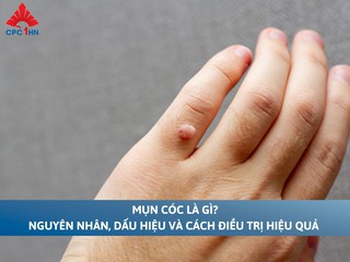 Mụn cóc là gì? Nguyên nhân, dấu hiệu và cách điều trị hiệu quả
