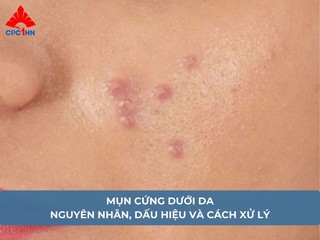 Mụn cứng dưới da: Nguyên nhân, dấu hiệu và cách xử lý