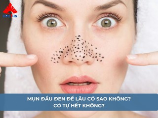Mụn đầu đen để lâu có sao không? Có tự hết không?