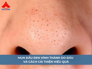 Mụn đầu đen hình thành do đâu và cách cải thiện hiệu quả