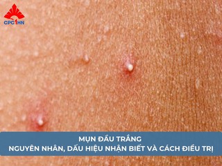 Mụn đầu trắng: Nguyên nhân, dấu hiệu nhận biết và cách điều trị
