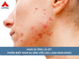 Mụn dị ứng là gì? Phân biệt mụn dị ứng với các loại mụn khác