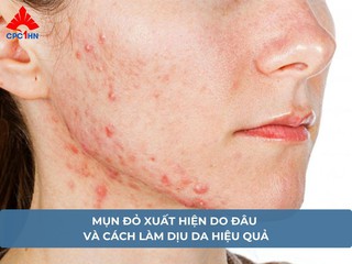 Mụn đỏ xuất hiện do đâu và cách làm dịu da hiệu quả